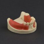 تصویر مدل ایمپلنت فک پایین با لثه نرم و بافت استخوانی Hoss