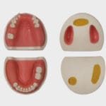 مدل فک ایمپلنت و سینوس لیفت Hoss