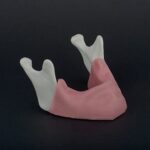 مندیبل آتروفی و خروجی های عصب همراه بافت نرم Hoss