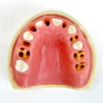 فک بالا ساکت دندانی ایمپلنت برند Hoss